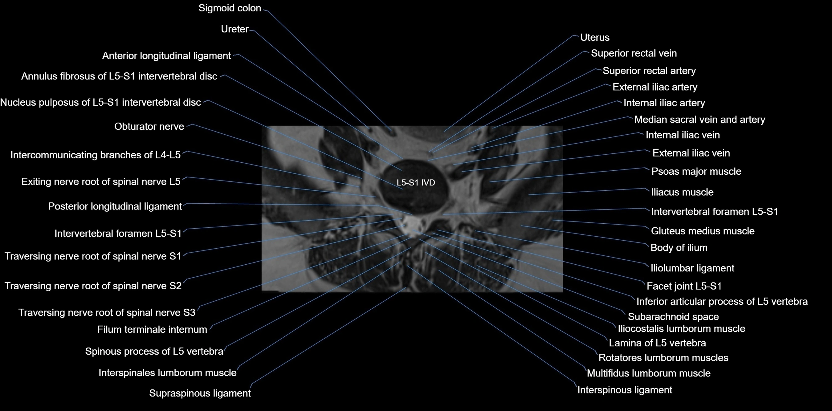 MRI sacrum, coccyx and sacroiliac joint axial cross sectional anatomy 3T  radiology  image-img-00001-00005.webp